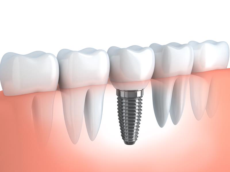 Dental Implants Seattle, WA