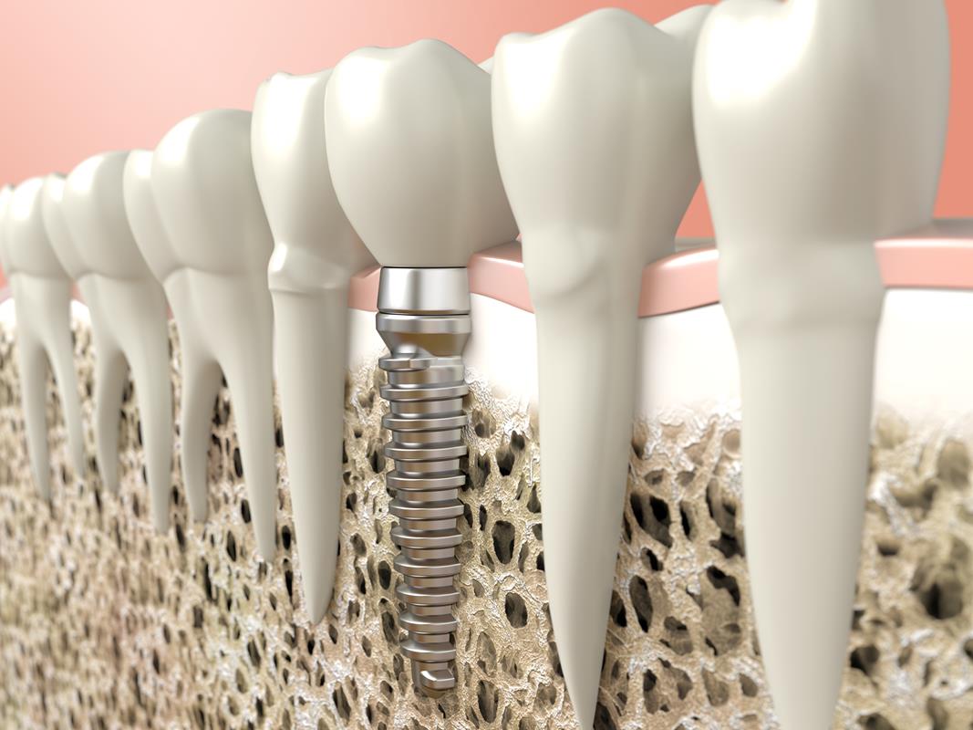 Dental Implants Seattle, WA