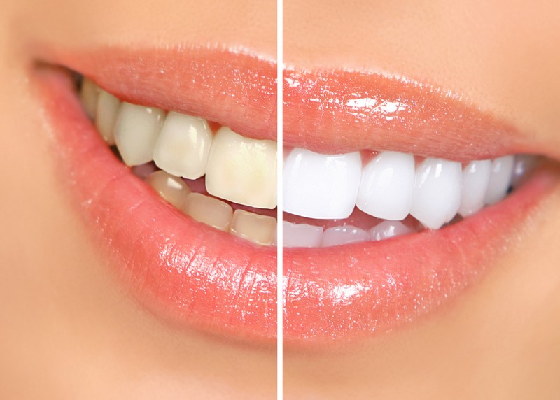 Teeth Whitening Seattle, WA