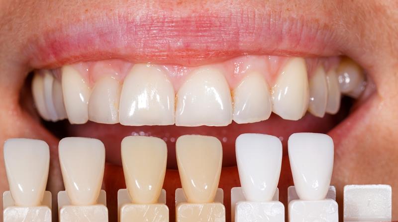 Veneers Seattle, WA 